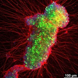 Immunofluorescence staining of a patient specific induced motor neuron markers.